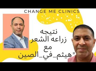 زراعه الشعر | Change Me Clinic
