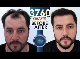 
Dr Resul Yaman Hair Clinic - 3760 Grafts Before - After