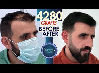 
Dr Resul Yaman Hair Clinic - 4280 Grafts Before - After