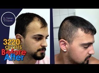 
Dr Resul Yaman Hair Clinic - 3220 Grafts Before - After