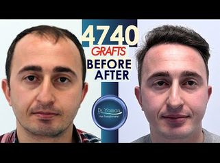 
Dr Resul Yaman Hair Clinic - 4740 Grafts Before - After