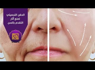 
الحقن التجميلي لمنع علامات التقدم بالسن مع الدكتور محمد حمدان | عيادات هابي سمايل