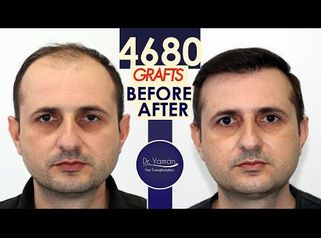 
Dr Resul Yaman Hair Clinic - 4680 Grafts Before - After