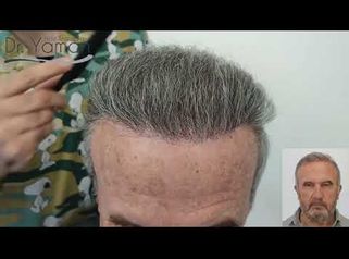
Dr Resul Yaman Hair Clinic - 3540 Grafts Before - After